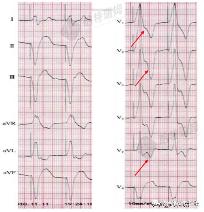 t波倒置9个真相图解,t波倒置判断口诀