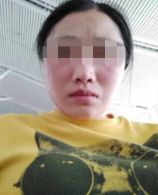 江西南昌荣美会祛斑,美容院祛斑毁容案例