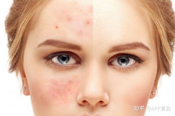 刷酸对闭口粉刺有用吗,刷酸可以解决闭口粉刺吗