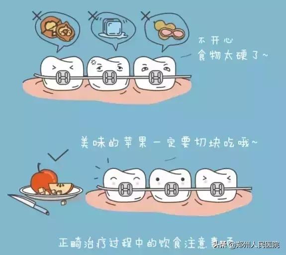 牙箍什么时候戴合适,14岁戴牙箍要戴多久