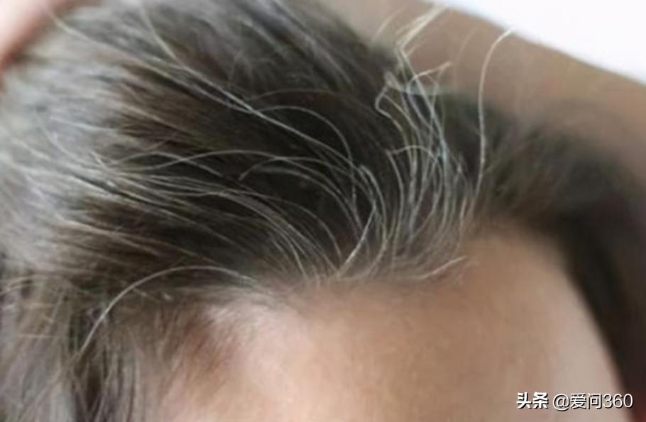 头发白严重怎么补救,头发白是什么原因怎么改善