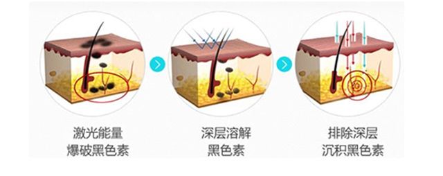 激光祛痣用什么药祛疤,激光点痣留疤几率多大