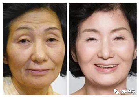 射频仪器对人体的伤害,射频仪危害