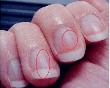指甲有竖条纹是大病的前兆吗,指甲出现褐色竖纹代表什么病