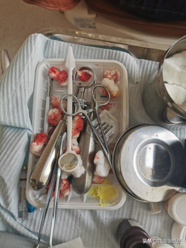 拔智齿横向阻生,拔智齿阻生牙是什么样