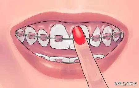 矫正牙齿医生叫打骨钉可以不打吗,正畸打骨钉当天就要挂橡皮筋了吗