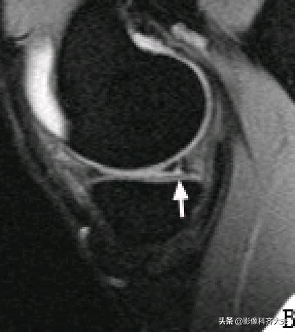 膝关节半月板损伤的磁共振,膝关节半月板病变的mri诊断与鉴别