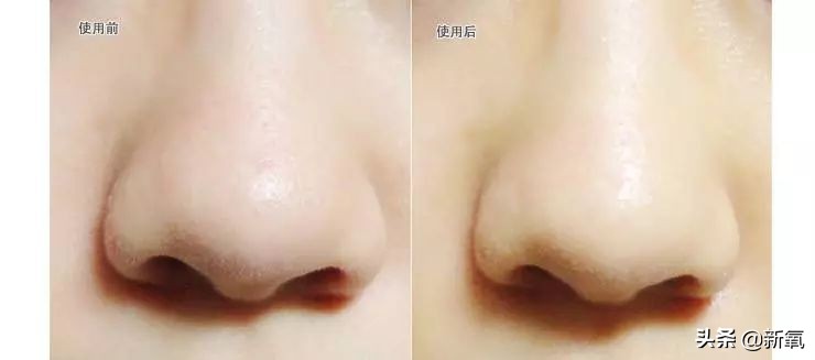 五分钟教你有效去黑头,最火去黑头收缩毛孔