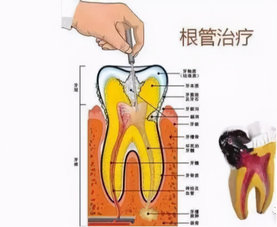 牙齿残根不疼不拔好吗,牙齿残根不疼