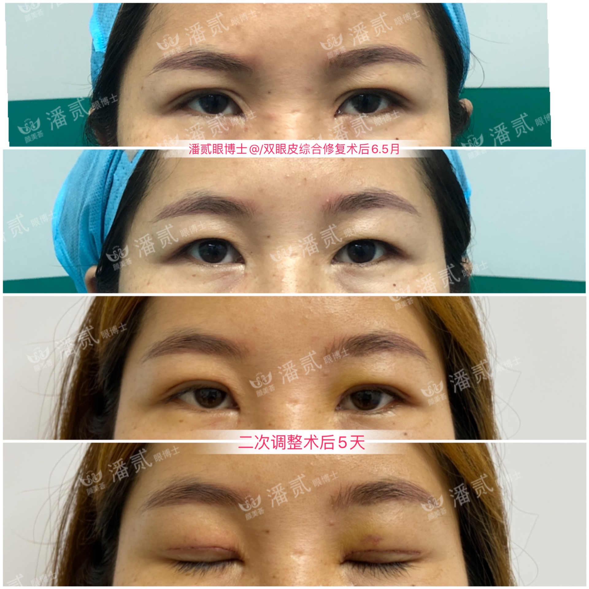 双眼皮术后变内双怎么办,双眼皮术后为啥变内双了