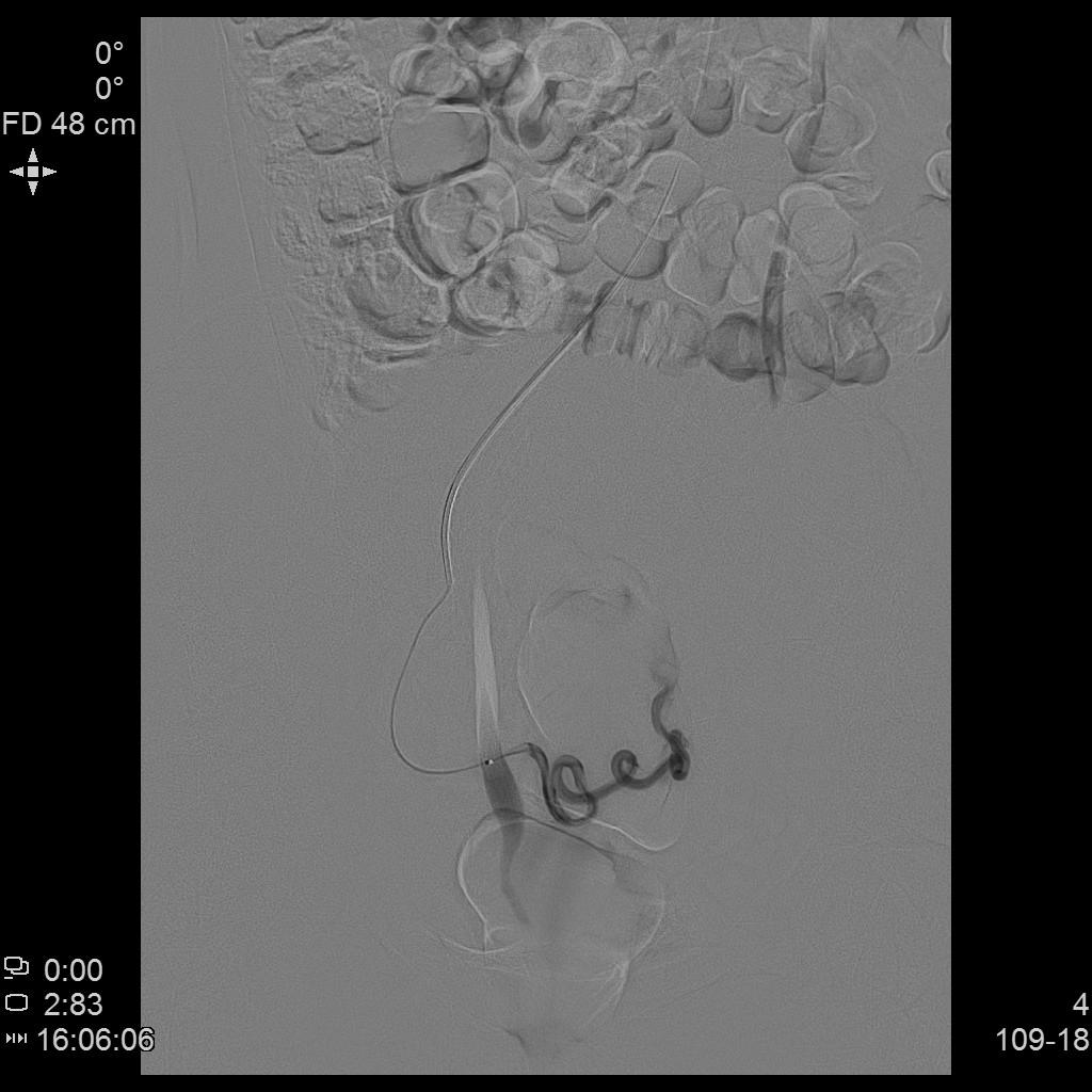 子宫肌瘤介入栓塞对子宫影响,子宫肌瘤介入栓塞治疗的危害