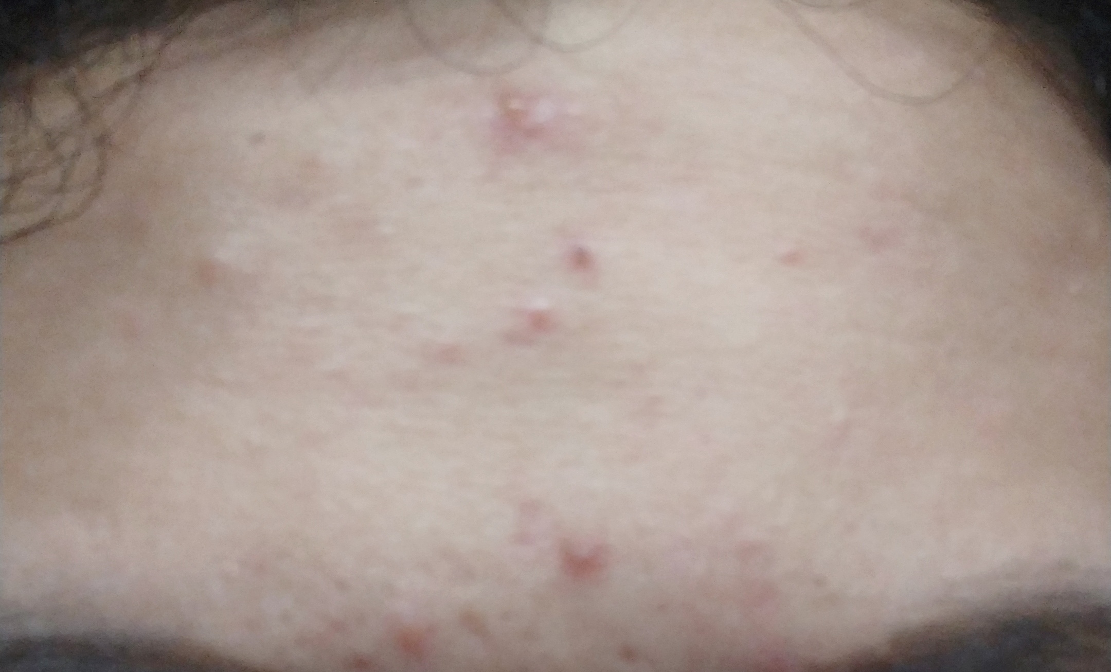 有哪些好用的祛痘印药膏 (超好用祛痘印药膏推荐一下)