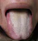 中医舌诊从零开始学齿痕舌,国医大师柴嵩岩舌诊