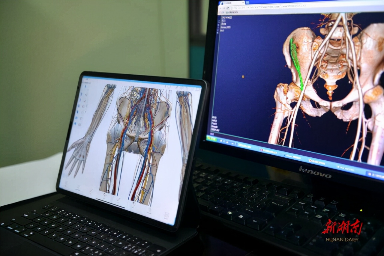 湖南湘雅首例机器人手术,国际上治疗股骨头坏死新技术
