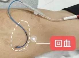 护士picc导管维护,护士picc相关知识薄弱