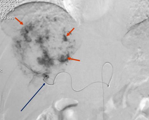 各种肿瘤并发症介入治疗,肿瘤和癌症早期怎么预防