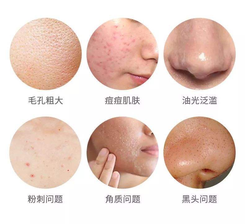 解决黑头最有效的方法,解决黑头最正确的方式