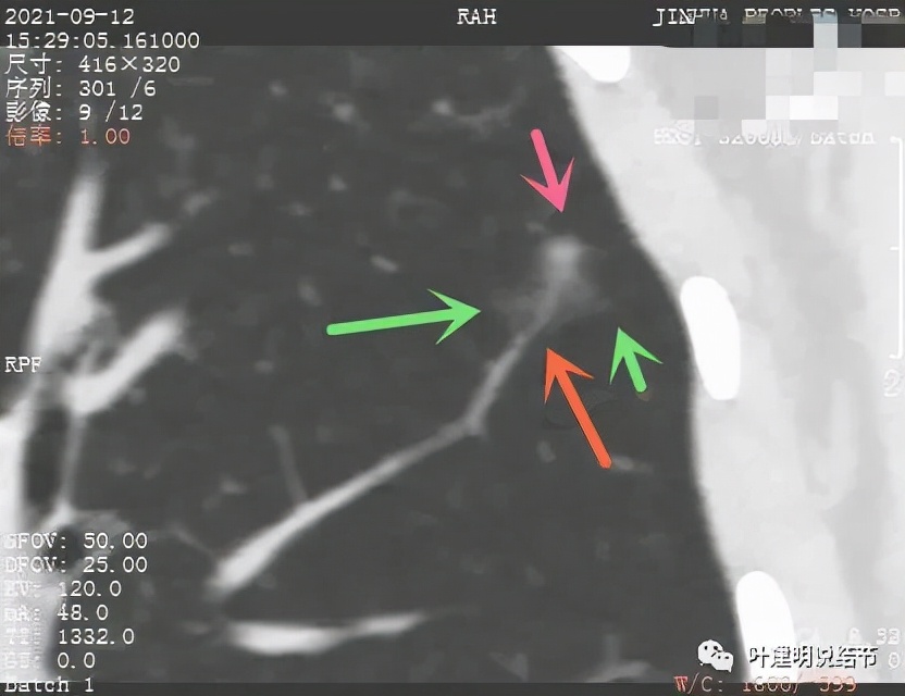 怎样从病理报告看是不是原位癌,原位腺癌切除子宫要开刀吗