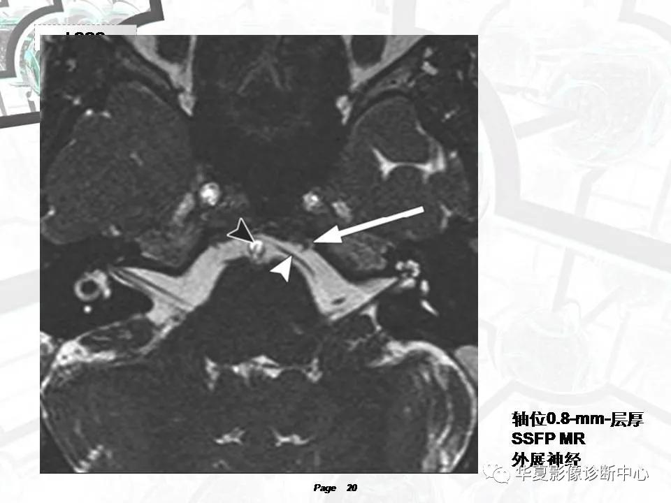 磁共振颅神经扫描是定位在哪,颅神经图谱