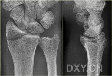 所有骨折都叫什么名字,骨折的名称有哪些