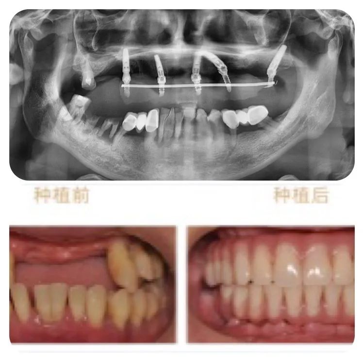 泰康拜博口腔种牙2980元,泰康拜博口腔种植技术