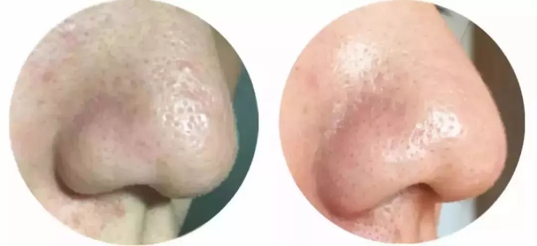 解决黑头的2种药,解决黑头的最好方法