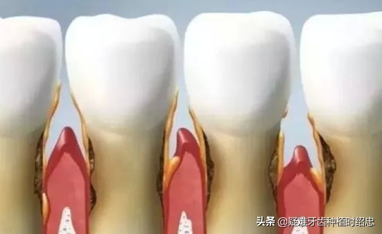 牙缝大是福是祸,牙缝宽什么命运