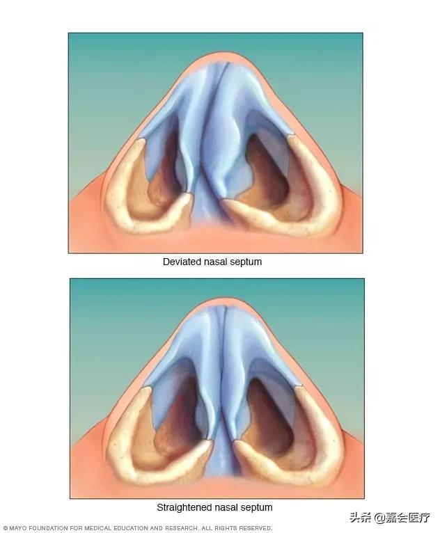 治好打鼾其实很简单的,通过手术能彻底治好打鼾吗