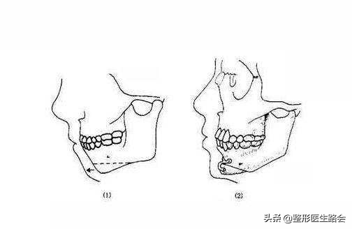 有几种下巴,有三个下巴是为什么