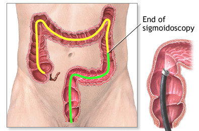 婴幼儿肠套叠的三大典型症状,慢性肠套叠的症状婴儿