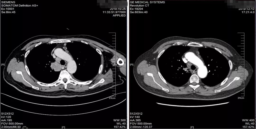 肺癌晚期可以靶向加免疫治疗吗,肺癌晚期化疗加免疫治疗有效吗