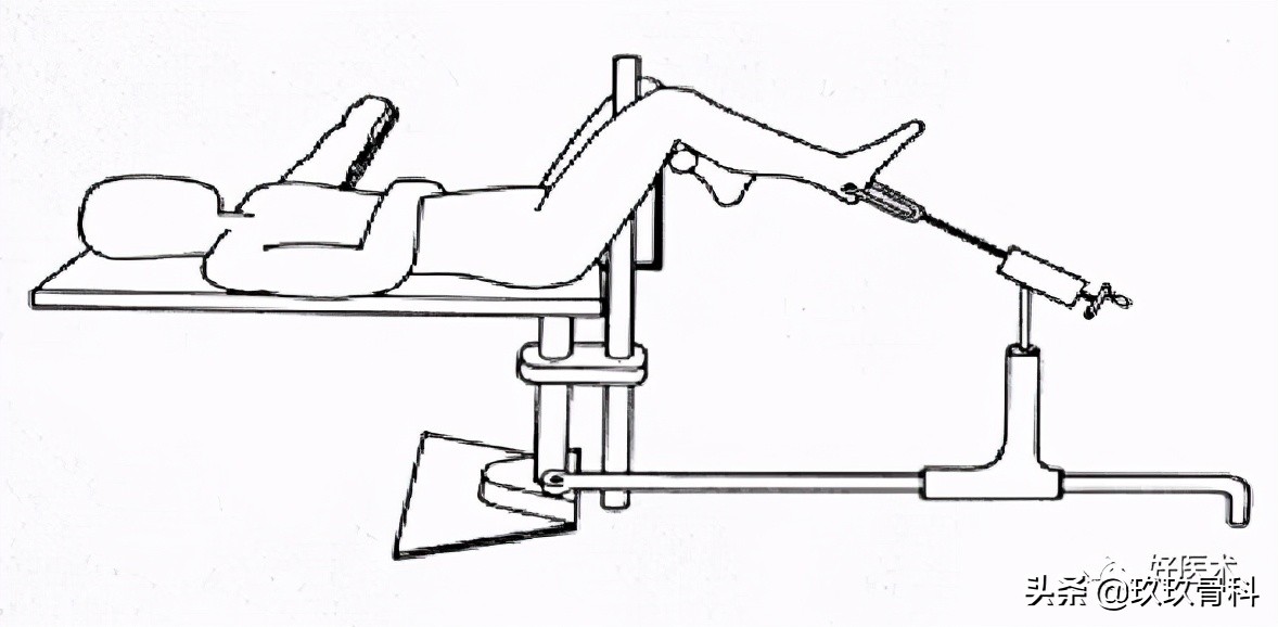 髓内钉技巧,髓内钉教学视频讲解
