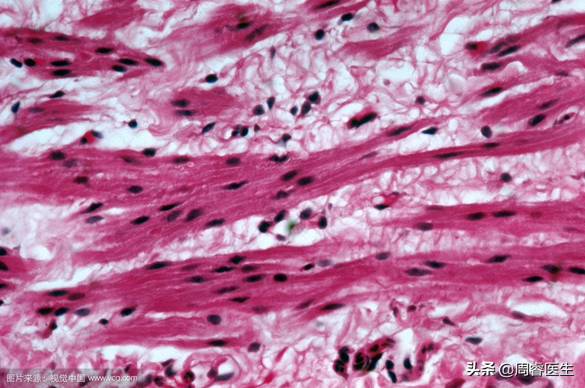 警惕平滑肌收缩引起的疾病（痉挛、头痛、痛经等）