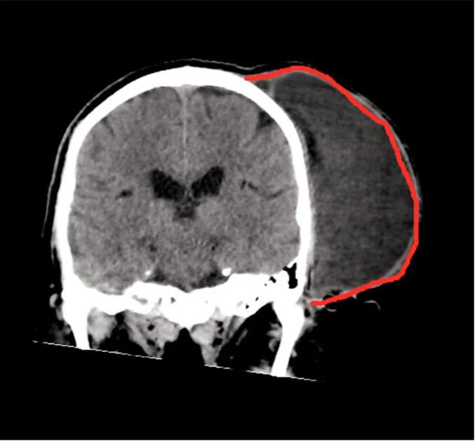 60岁大爷头皮长了个小疙瘩,头皮上长了一个豆粒大小的肉疙瘩
