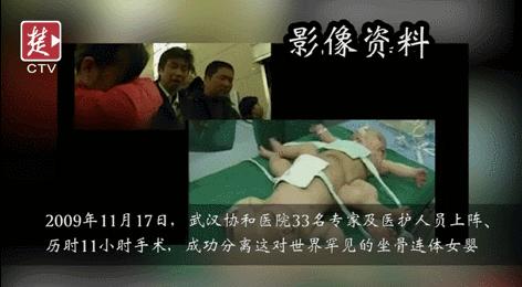 坐骨连体双胞胎多大分离,中国首例坐骨婴儿手术成功完整版