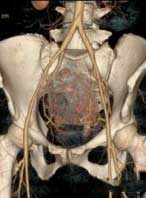 子宫肌瘤腺肌症微创介入科普动画,子宫肌瘤适合微创手术吗