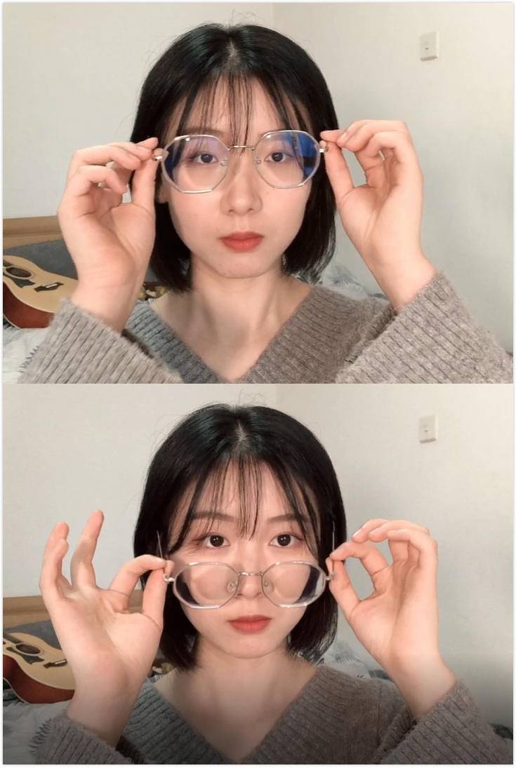 近视手术真实案例分享博主,近视屈光手术亲身经验