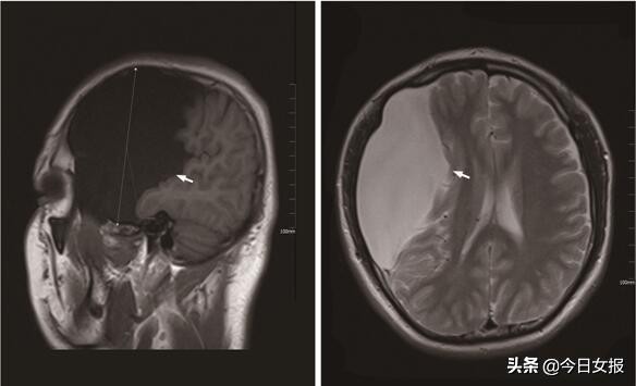 小伙子脑袋进水了,脑子囊肿是气泡还是水泡