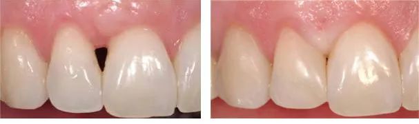 牙龈上有白色的牙垢刷不掉,牙龈里的黑东西