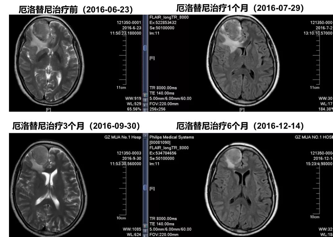 豪森药业阿美替尼治疗厄洛替尼经治T790M+肺腺癌伴脑转移病例分享
