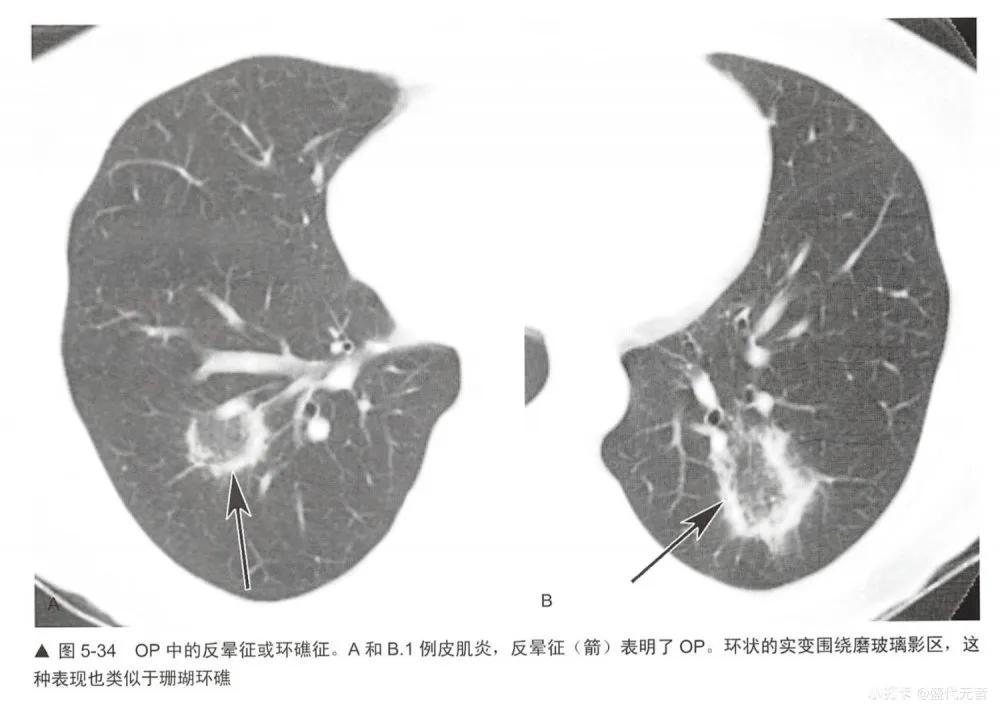 肺HRCT图像特征是什么,肺hrct诊断思路
