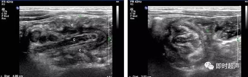 小儿消化道急症超声