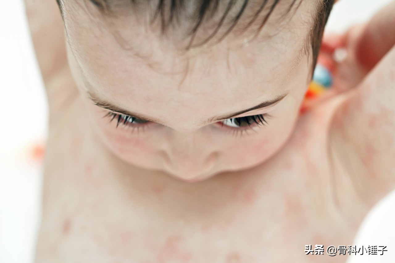 得了湿疹不要怕湿疹也有克星,湿疹样皮炎和湿疹有啥区别