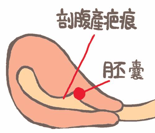 高龄产妇顺产有什么风险,高龄产妇怀孕的风险有哪些