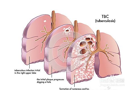 刘广正讲中医内科——肺痨（适合中医发烧友和考研学子）