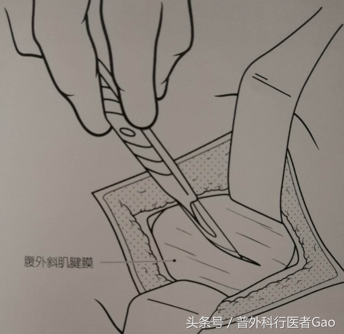 鏉忎粊鑳芥不闃戝熬鐐庡悧,鏉忎粊鍒囬櫎