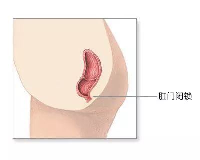 刚生下的男婴没肛怎么办,出生的孩子无肛直肠瘘