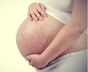 孕妇油预防妊娠纹,孕妇怎样预防妊娠纹抹什么