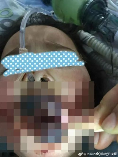 孩子烫伤后发低烧是怎么回事,烫伤三度怎么治疗