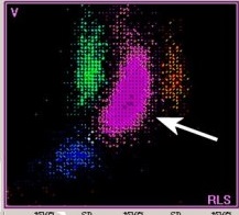 儿童血常规化验单怎么看白细胞,血常规化验单白细胞和超敏关系